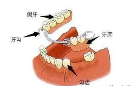 活动义齿固定义齿种植牙三大修复对比及优缺点
