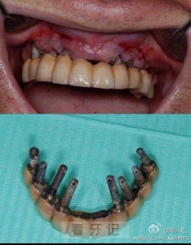 做种植牙的人都太傻了附全口种植牙失败案例图片
