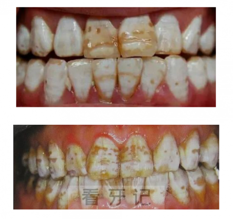 氟斑牙轻度中度重度图片