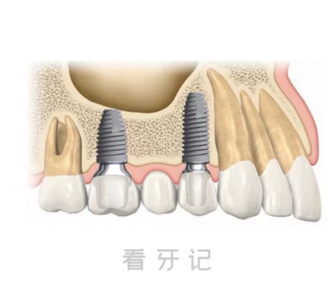 什么人可以做即拔即种种植牙为什么我不能做即刻种植牙