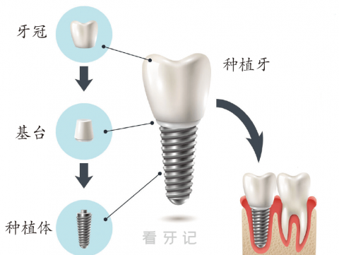 广东省口腔医院种植牙科普附种牙真实过程图片