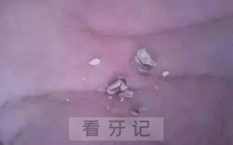 自己清除抠掉牙结石有没有风险附牙结石图片