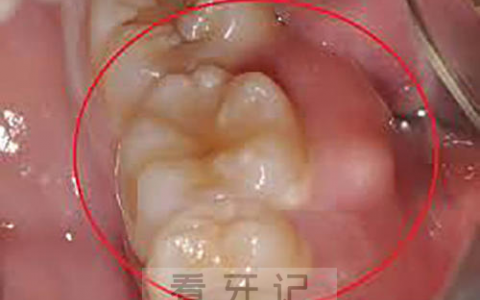 牙龈上面长了一个脓包很疼附高清图片