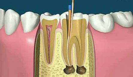 什么是根管治疗为什么比补牙贵这么多