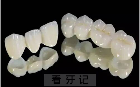 全瓷牙烤瓷牙五大区别