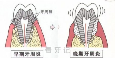 牙龈炎和牙周炎三大区别