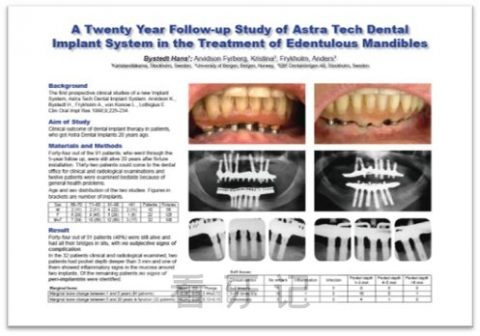 瑞典Astra种植牙七大优点优势