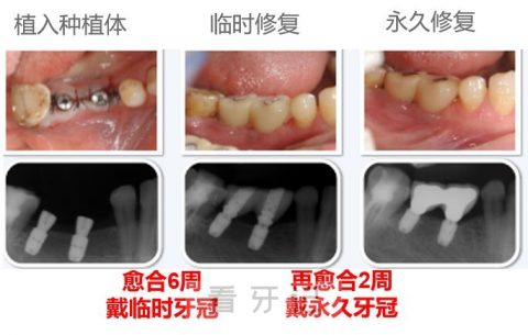 瑞典Astra种植牙七大优点优势