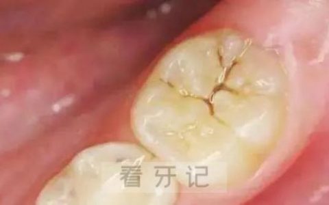 最新浅龋龋齿图片