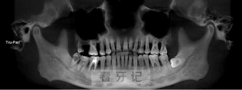 得了牙周炎要如何治疗附牙周炎可怕真实照片