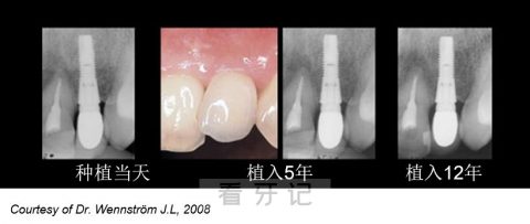 瑞典Astra种植牙七大优点优势