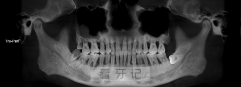 得了牙周炎要如何治疗附牙周炎可怕真实照片