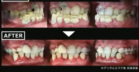 0年20年没洗牙的牙齿长什么样附高清牙结石图片"