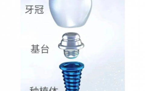种植牙一颗要花多少钱详细分解版2023