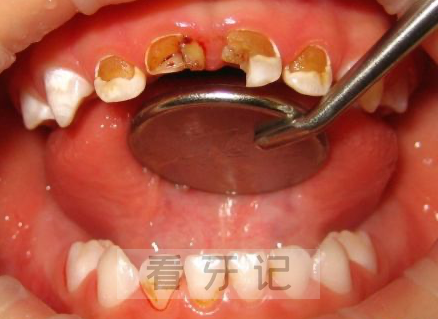 奶瓶龋齿危害太大了家长们长点心吧附高清图片