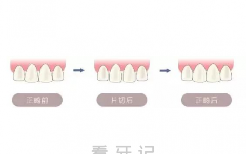 什么是片切对牙齿有没有伤害