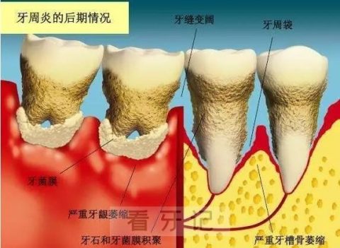 牙龈炎和牙周炎三大区别