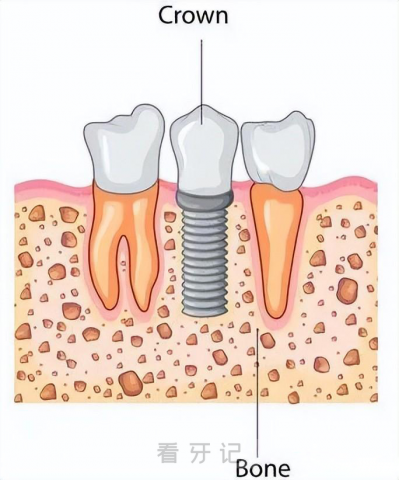 种植牙一期二期三期各需要多久附详细流程