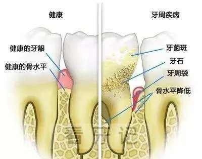 患上牙周病是不是这辈子就完蛋了附治疗手段和流程