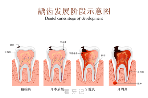 龋齿发展阶段示意图流程图