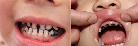 宝宝儿童黑牙齿发黑高清图片