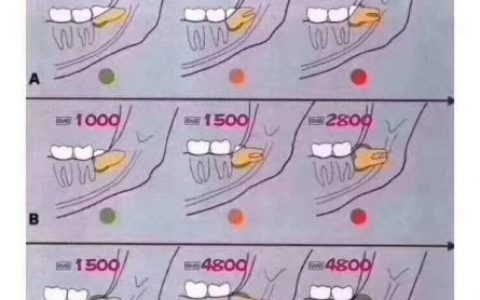 拔智齿要2000多我是不是被坑了附拔智齿价格表