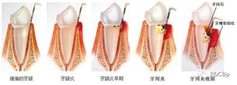 牙周病四大类型