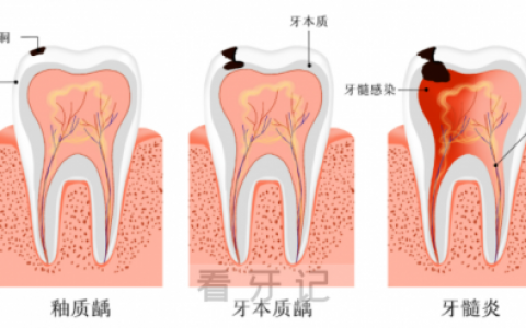 急性牙髓炎五大特点
