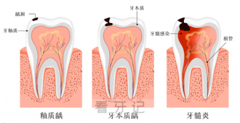 急性牙髓炎五大特点