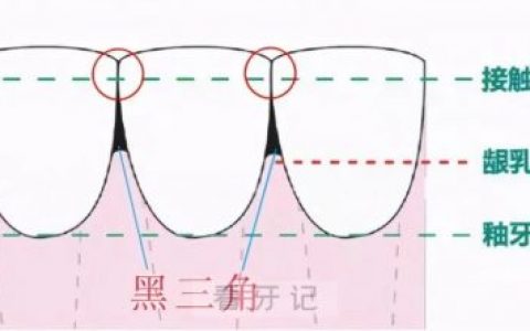 太可怕了牙齿矫正会导致黑三角牙龈萎缩是不是真的