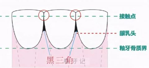 太可怕了牙齿矫正会导致黑三角牙龈萎缩是不是真的