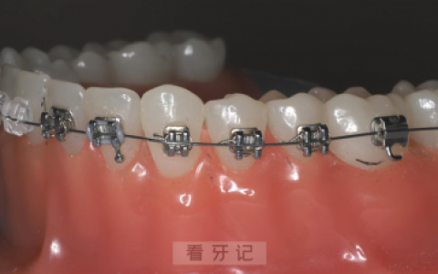 金属自锁托槽和普通金属托槽牙套哪个最好