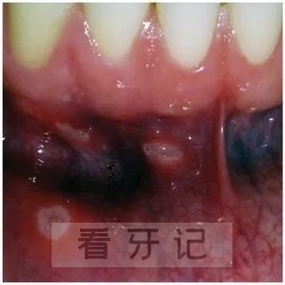 新冠阳性后口腔也会阳性？