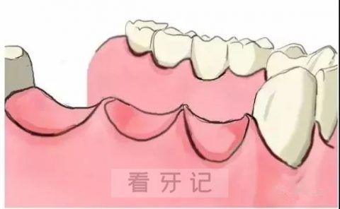 多颗种植牙手术步骤流程示意图2023版