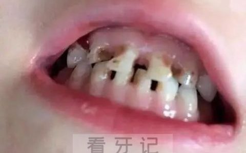 孩子乳牙严重蛀牙龋坏图片