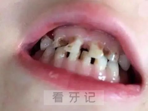 孩子乳牙严重蛀牙龋坏图片