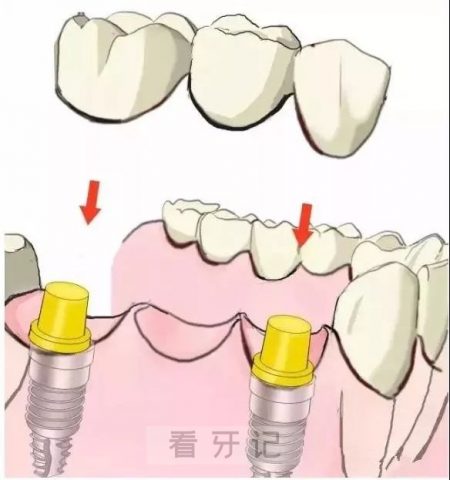 多颗种植牙手术步骤流程示意图2023版