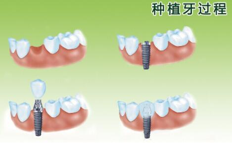 种植牙治疗过程大概需要多长时间