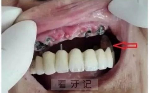 做完烤瓷牙不想活了非常后悔拆除烤瓷牙太疼了