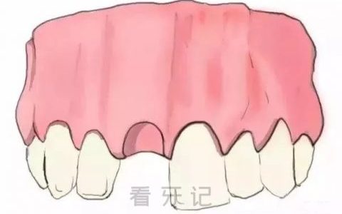 单颗种植牙手术步骤流程示意图2023版