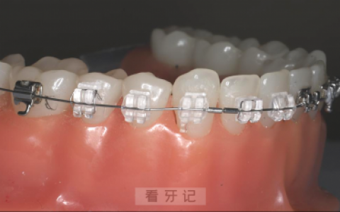 普通陶瓷托槽和陶瓷自锁托槽牙套哪个最好