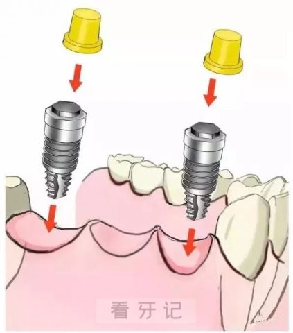 多颗种植牙手术步骤流程示意图2023版