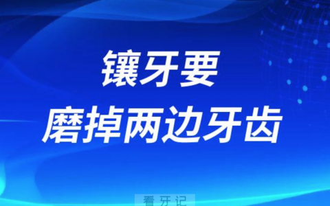 医生说镶牙要磨掉我两边的牙齿有没有问题