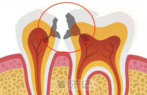 邻面龋有多可怕