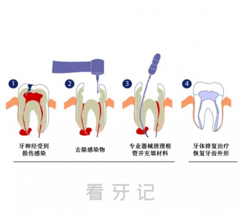 什么类型的牙齿需要做根管治疗