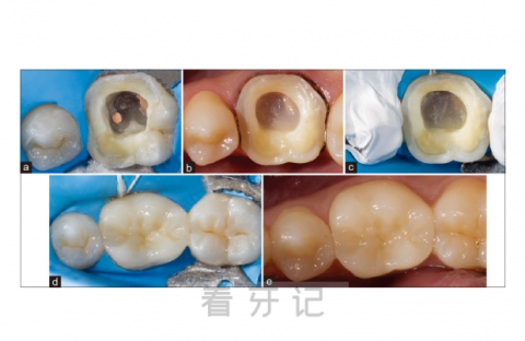 牙冠三大修复类型附修复过程图片