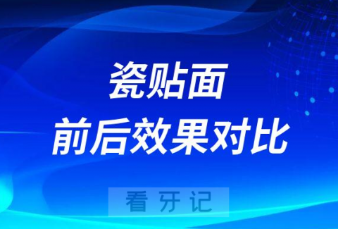 瓷贴面前后效果对比图真实照片