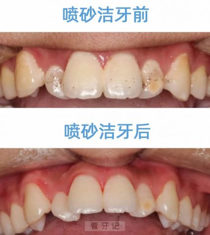 超声波洁牙喷砂洁牙哪个更好哪个性价比高