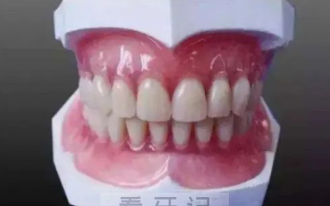 吸附性义齿真实案例看牙记
