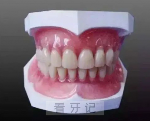 吸附性义齿真实案例看牙记